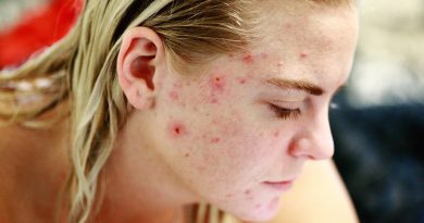 Cystic Acne Treatments