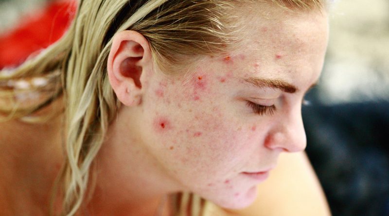 Cystic Acne Treatments